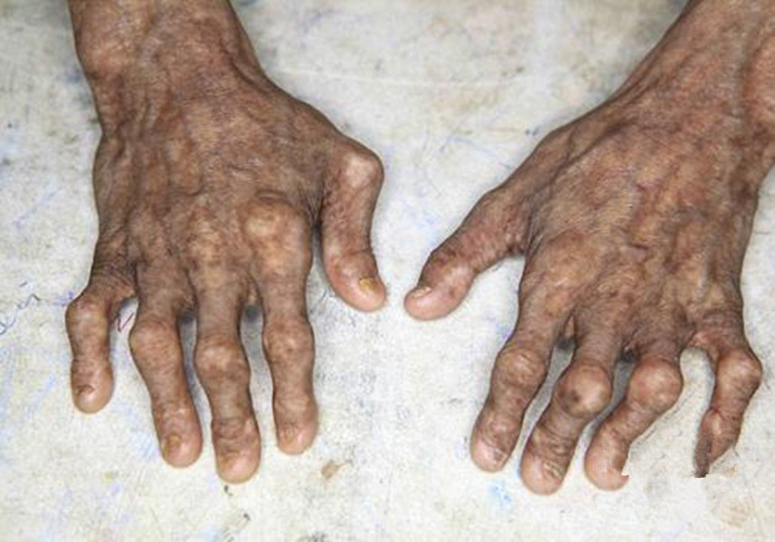皮膚黃色瘤病手部皮膚症狀