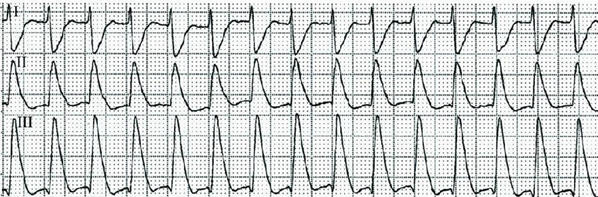 房顫心電圖特點 (68) 