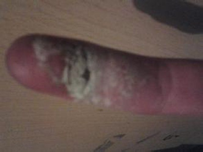 破傷風早期症狀