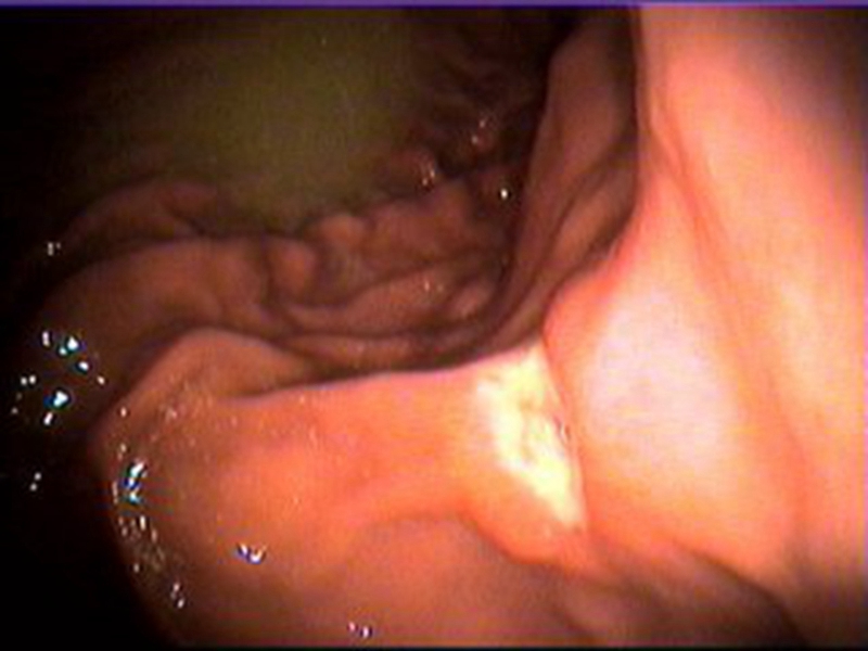 直腸腸腫瘤手術術後