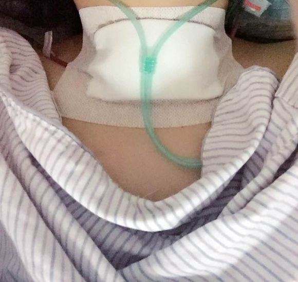 女性甲狀腺結節術後