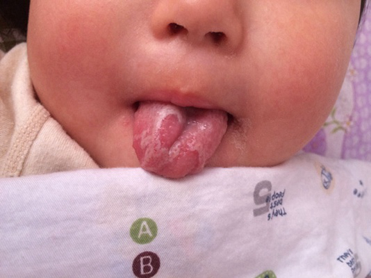 寶寶鵝口瘡 (73) 