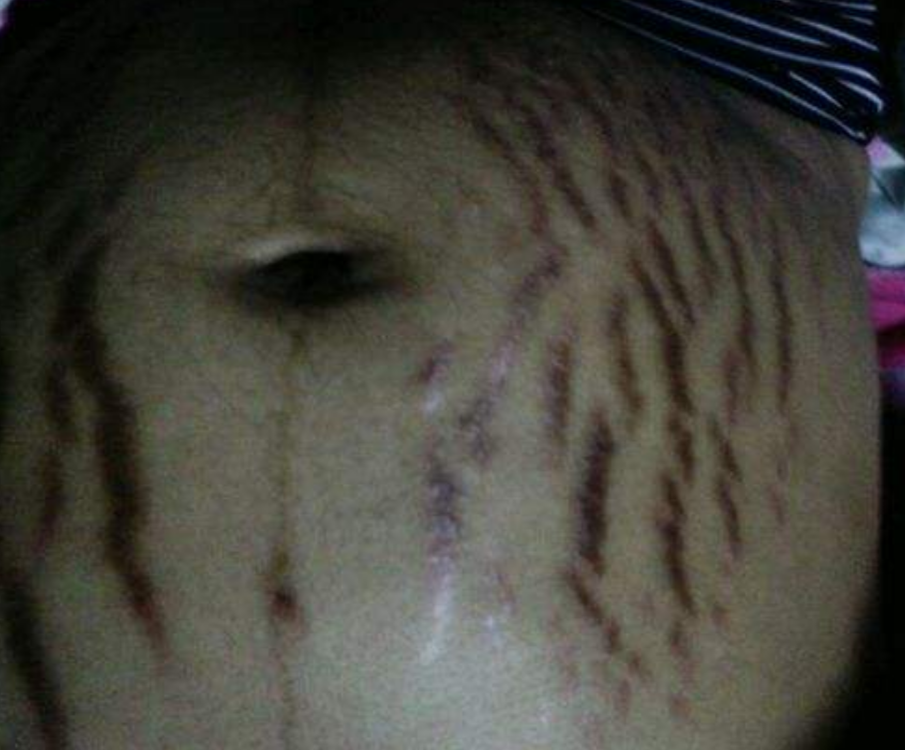 懷孕期肚皮妊辰紋