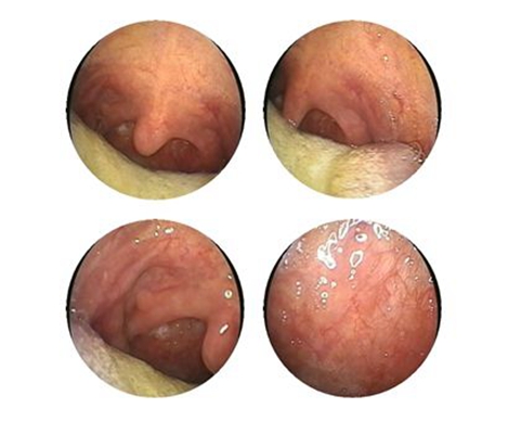 喉部淋巴濾泡增生 (38) 