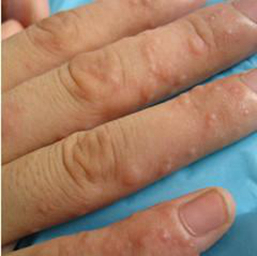 長在手部溼疹的