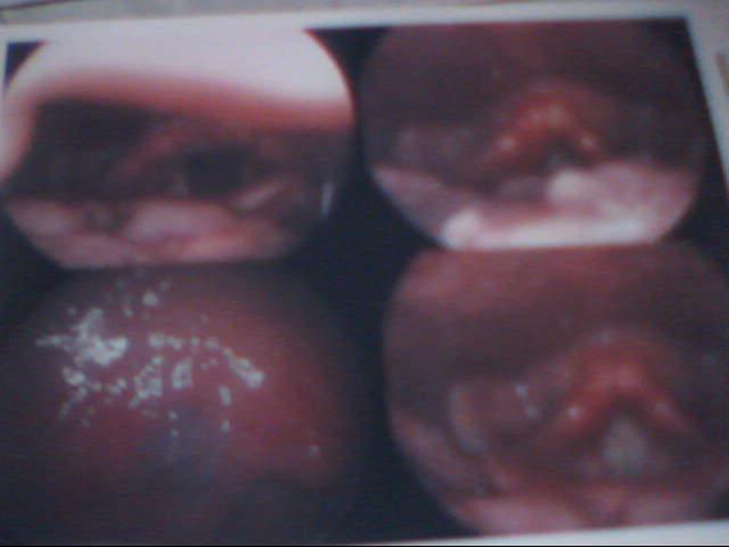 成人喉血管瘤檢查