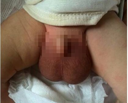 小兒鞘膜積液 (4) 