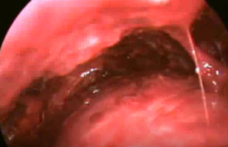 結核性胸膜炎胸腔鏡