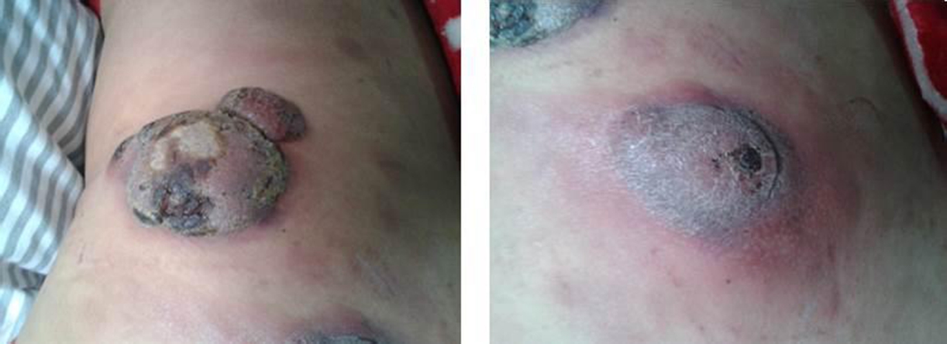 嚴重的腋下淋巴結髮炎