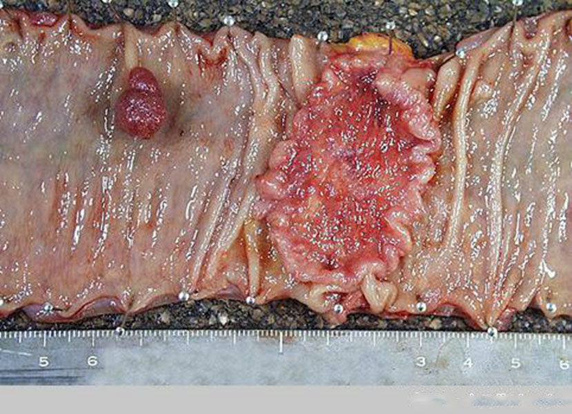 腫瘤腸腫瘤切除術