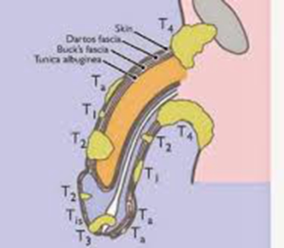 早期陰莖癌有什麼症狀