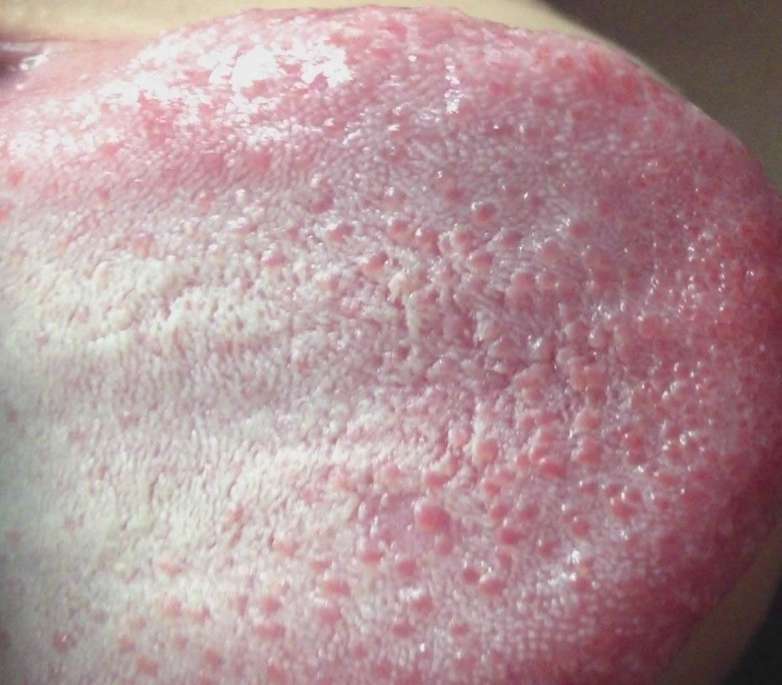 肛周溼疹有哪些症狀 