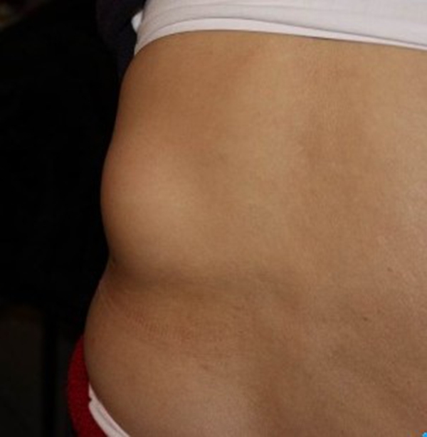 腹壁白線疝切口