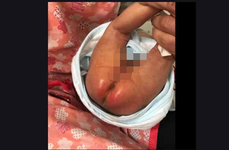 寶寶肛門溼疹症狀的