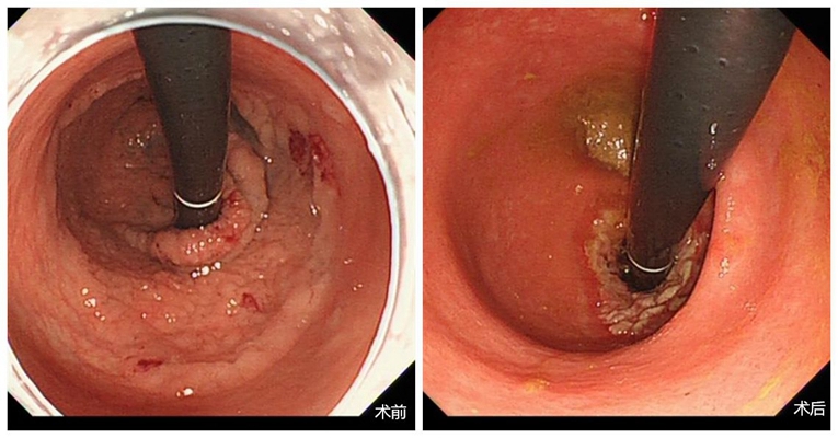 直腸癌晚期症狀 (54) 