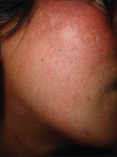 激素臉排毒症狀 (59) 