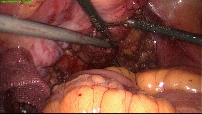 直腸癌晚期症狀 (37) 