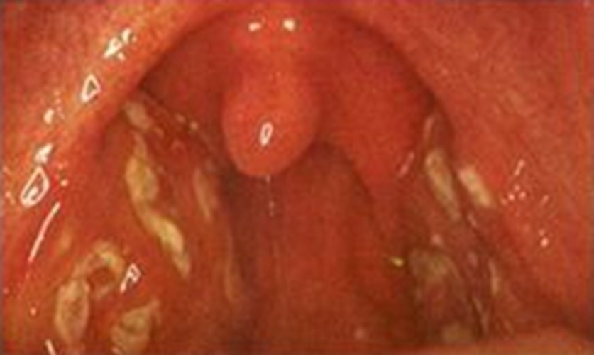 小孩的急性咽炎症狀的