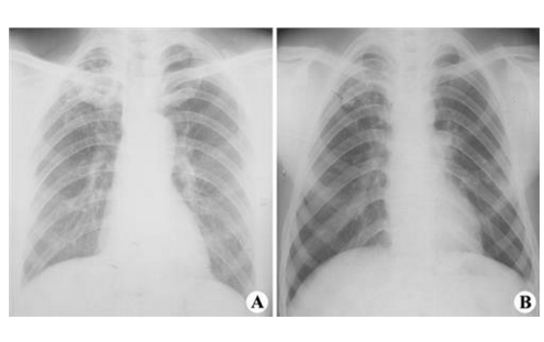 空洞型肺結核能活多久 (5) 