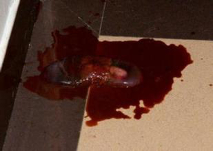 藥物流產的排出孕囊的真實