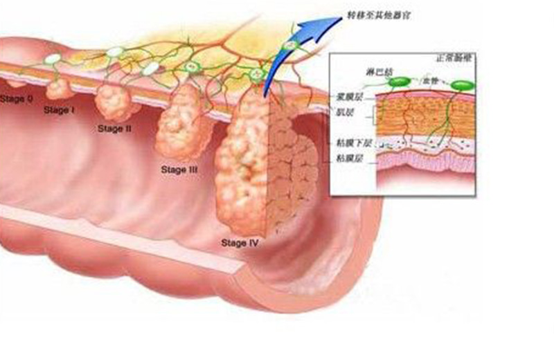 直腸息肉的症狀 