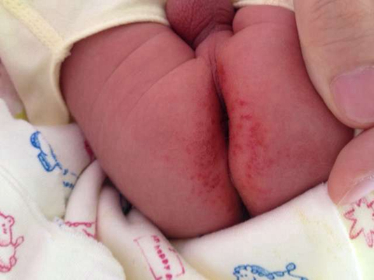 嬰兒肛周膿腫 (11) 