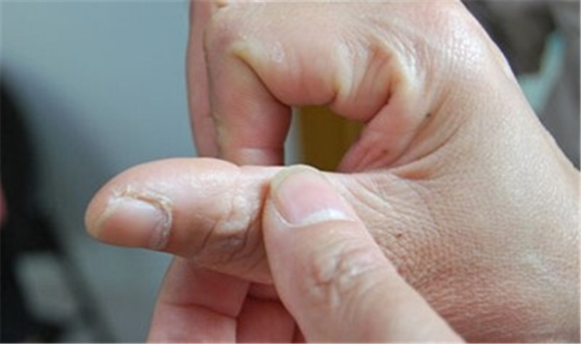 橈骨莖突狹窄性腱鞘炎