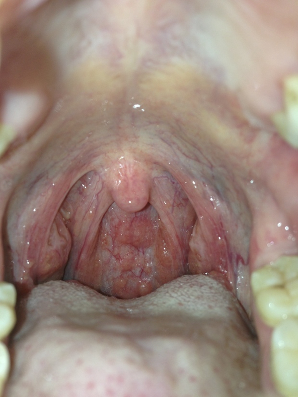 有沒有喉血管瘤