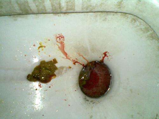 腸癌的症狀 (45) 