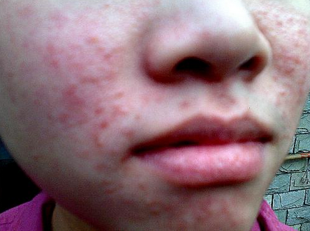 系統性紅斑狼瘡診斷標準 (50) 