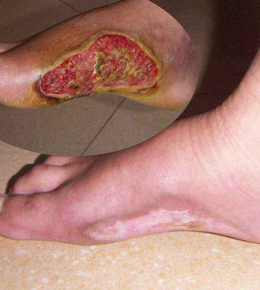 脈管炎早期症狀