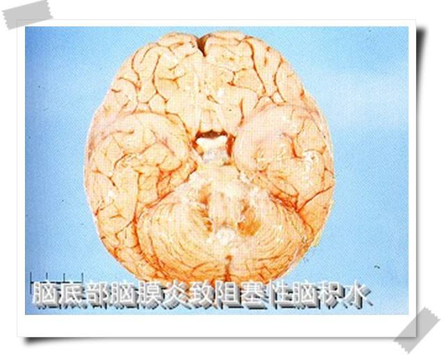 阻塞性腦積水病理