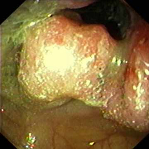 乙狀結腸癌潰瘍型症狀