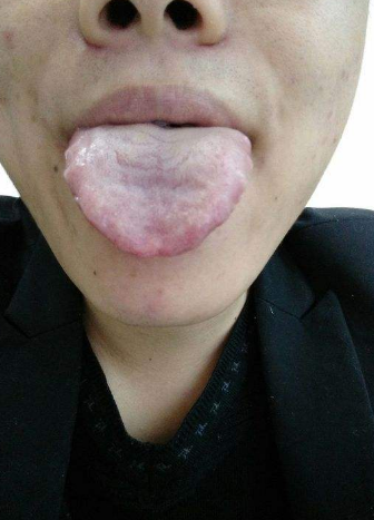 胃炎的症狀舌頭