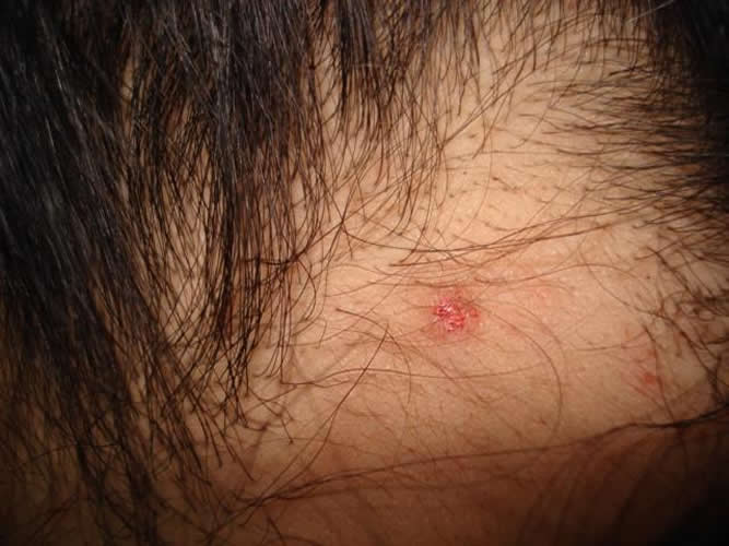 肛周溼疹怎麼治療好 