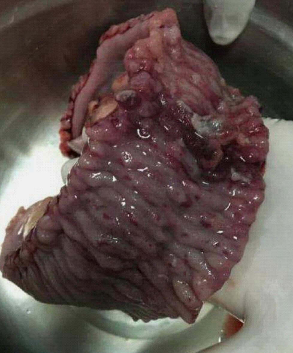 克羅恩病生理解剖