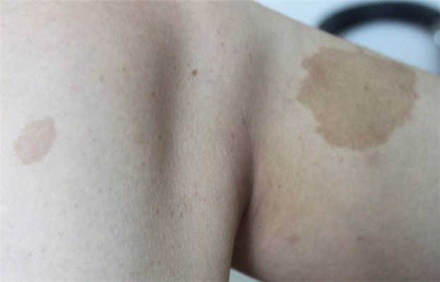 牛奶咖啡斑 (40) 