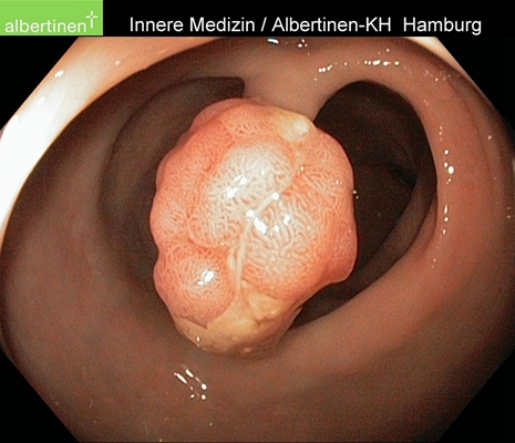 直腸癌晚期症狀 (43) 