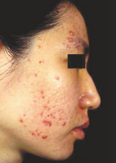 血熱的症狀痘痘