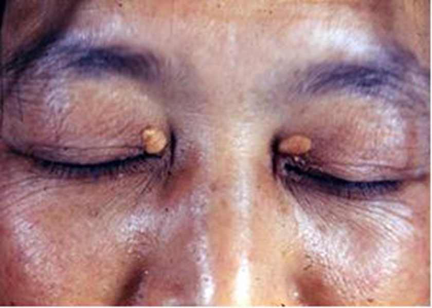 皮膚黃色瘤病臉部輕微潰爛