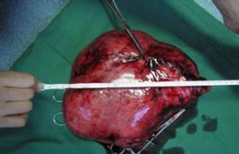 子宮漿膜下子宮肌瘤的