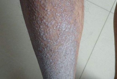 皮膚澱粉樣變 (5) 