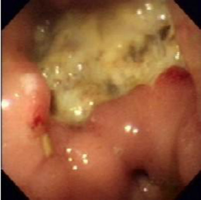 胃竇糜爛 (47) 