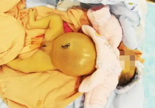 嬰兒男性假兩性畸形的