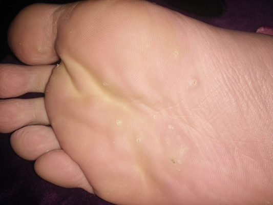 腳底蹠疣早期