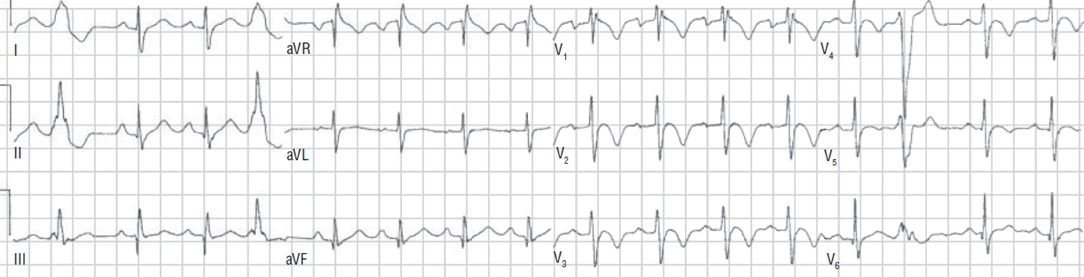 預激綜合徵心電圖 (89) 