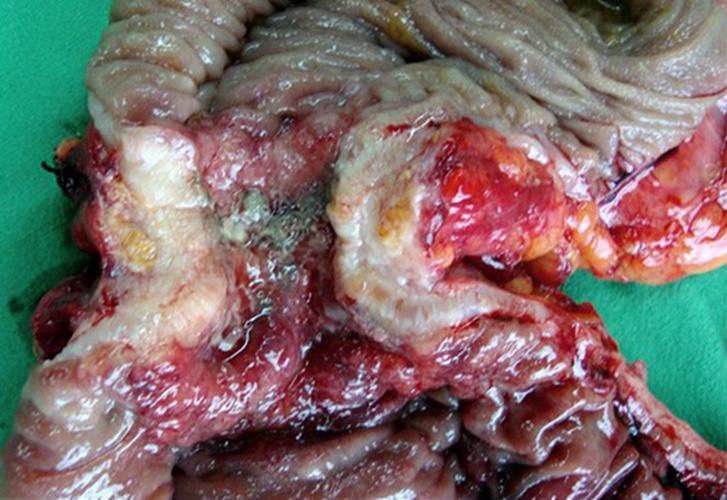 右半結腸癌腺癌一級