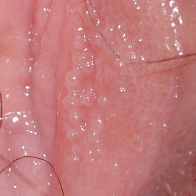 黴菌陰炎症狀 (7) 