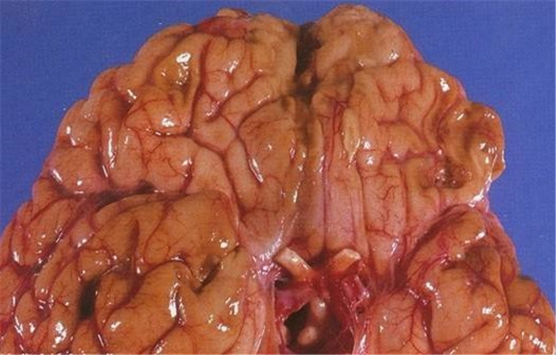 外傷性腦梗塞腦部