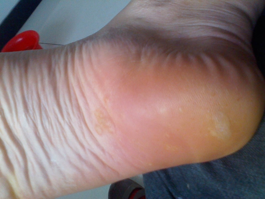腳底蹠疣早期